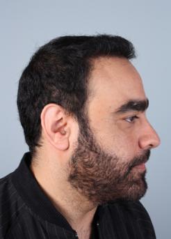 After Hair Transplant&nbsp;2 Sessions (Areas)